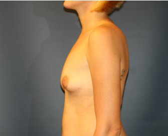 Round Silicone Gel Breast Implants - before - side