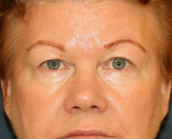 Upper Eyelid Skin Removal - before - front