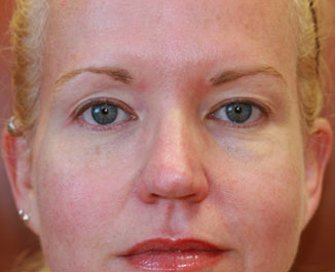 Blepharoplasty Case 26 - before - front