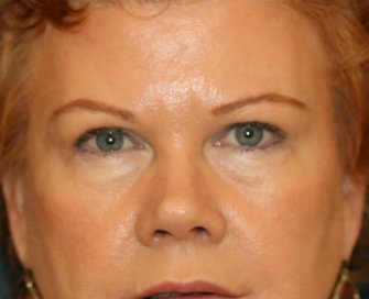 Upper Eyelid Skin Removal - after - front