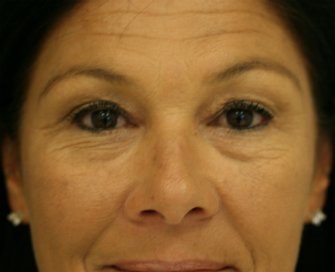Lower eyelid tightening surgery - before - front