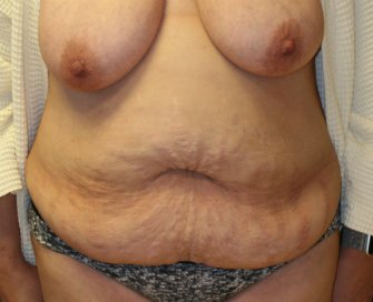 Tummy Tuck San Diego 83 - before - front