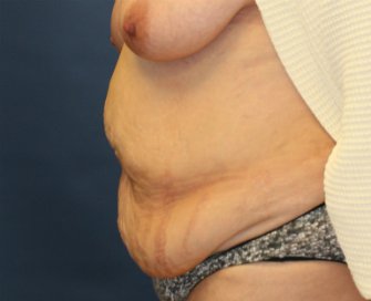 Tummy Tuck San Diego 83 - before - side