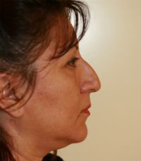 Rhinoplasty Case 11 - before - front