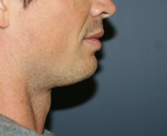 Chin Implant for Men - before - front