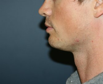 Chin Implant for Men - before - Left side