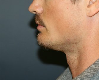 Chin Implant for Men - after - Left side