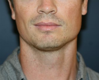Chin Implant for Men - before - Right side