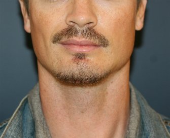 Chin Implant for Men - after - Right side