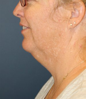 Necklift and Corner of Lip Lift - before - front