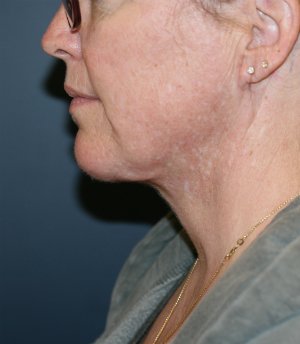 Necklift and Corner of Lip Lift - after - front