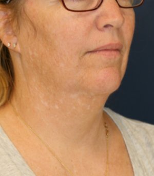 Necklift and Corner of Lip Lift - before - oblique