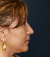 Rhinoplasty Case 11 - after - front