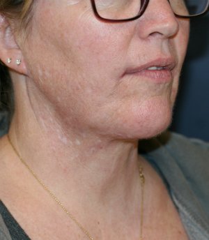 Necklift and Corner of Lip Lift - after - oblique