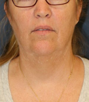 Necklift and Corner of Lip Lift - before - side