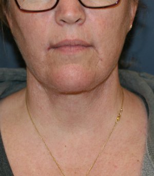 Necklift and Corner of Lip Lift - after - side