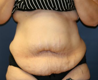 Tummy Tuck San Diego 84 - before - front