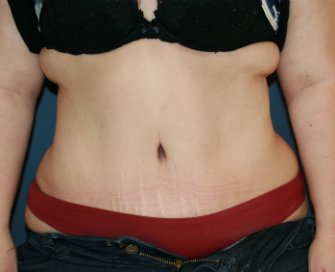 Tummy Tuck San Diego 84 - after - front