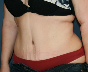 Tummy Tuck San Diego 84 - after - oblique
