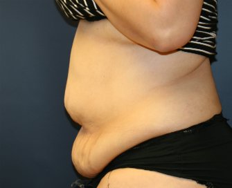 Tummy Tuck San Diego 84 - before - side