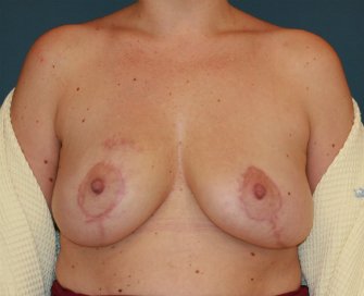 Breast Reduction San Diego 24 - after - front