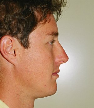 Rhinoplasty Case 12 - after - front