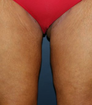 upper thigh-lift-san-diego - after - back