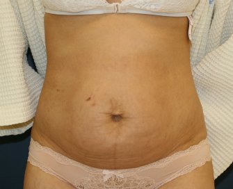 Tummy tuck San Diego 85 - before - front