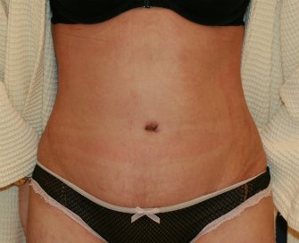 Tummy tuck San Diego 85 - after - front