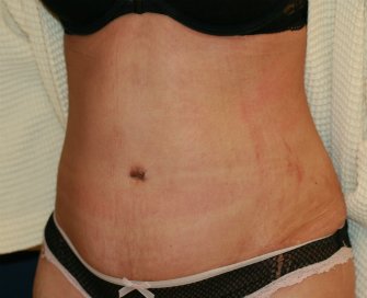 Tummy tuck San Diego 85 - after - oblique