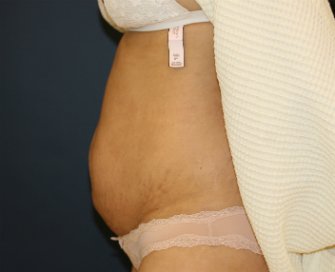 Tummy tuck San Diego 85 - before - side