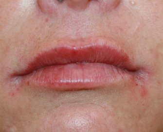 Filler (Glucuronic Acid) in Upper and Lower Lips - after - front
