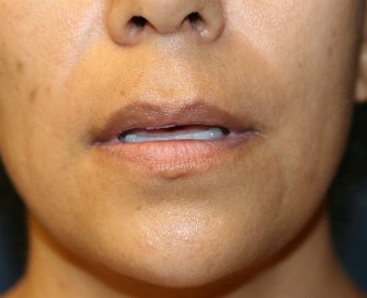 Lip Lift Before and After - before - front