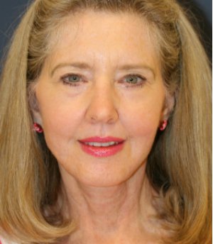 Necklift and Lower Face with Laser - after - front