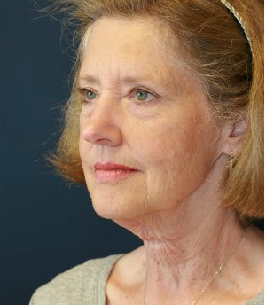 Necklift and Lower Face with Laser - before - oblique