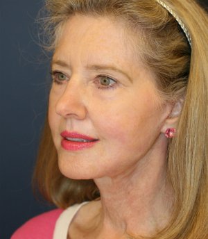 Necklift and Lower Face with Laser - after - oblique