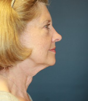 Necklift and Lower Face with Laser - before - side