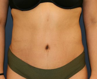 Tummy Tuck San Diego 86 - after - front