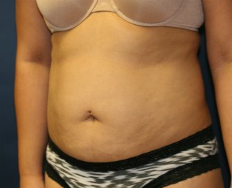 Tummy Tuck San Diego 86 - before - oblique