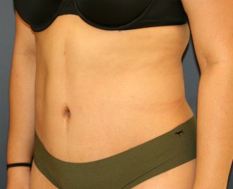 Tummy Tuck San Diego 86 - after - oblique