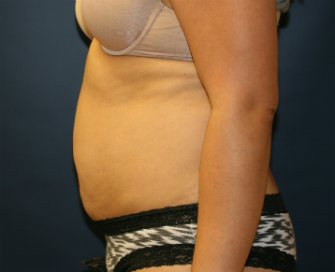 Tummy Tuck San Diego 86 - before - side