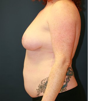 Breast Lift, Tummy, Lipo - before - side