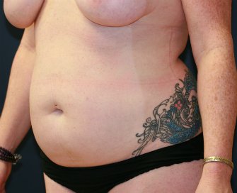 Tummy Tuck San Diego 87 - before - front