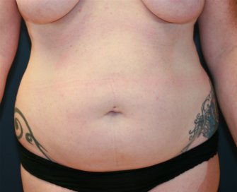 Tummy Tuck San Diego 87 - before - oblique