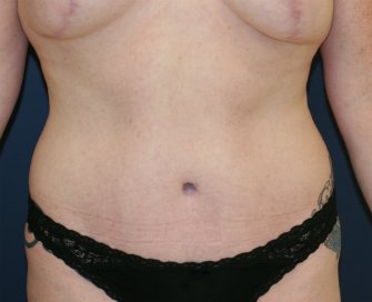 Tummy Tuck San Diego 87 - after - oblique