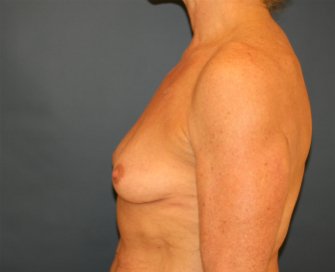 Breast Implants - before - side