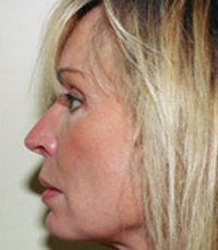 Rhinoplasty Case 15 - before - front