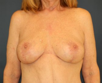 Breast Implant Removal with Breast Lift - after - front