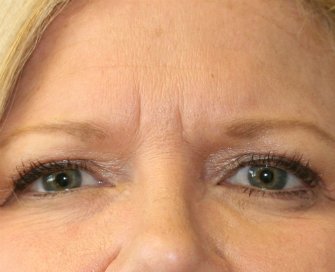 Filler (hyaluronan) into squint lines - before - front