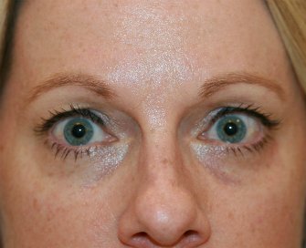 Filler beneath lower eyelids - before - front